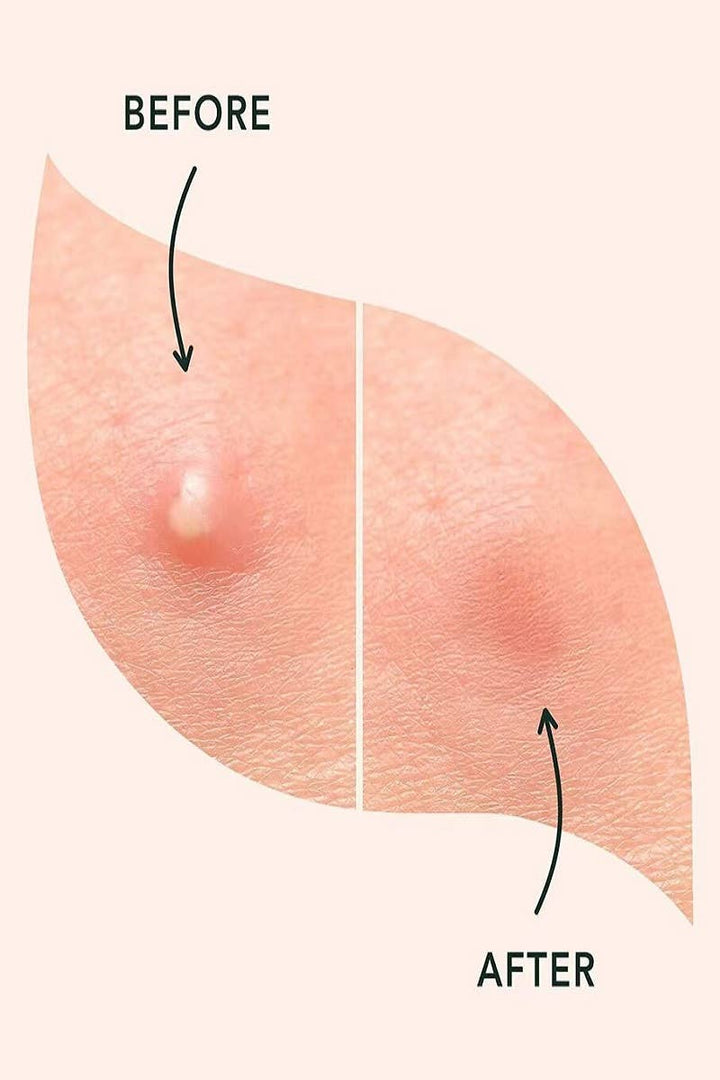 The Original Hydrocolloid Acne Pimple Patch-Box of 36