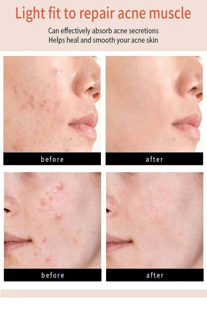 The Original Hydrocolloid Acne Pimple Patch-Box of 36
